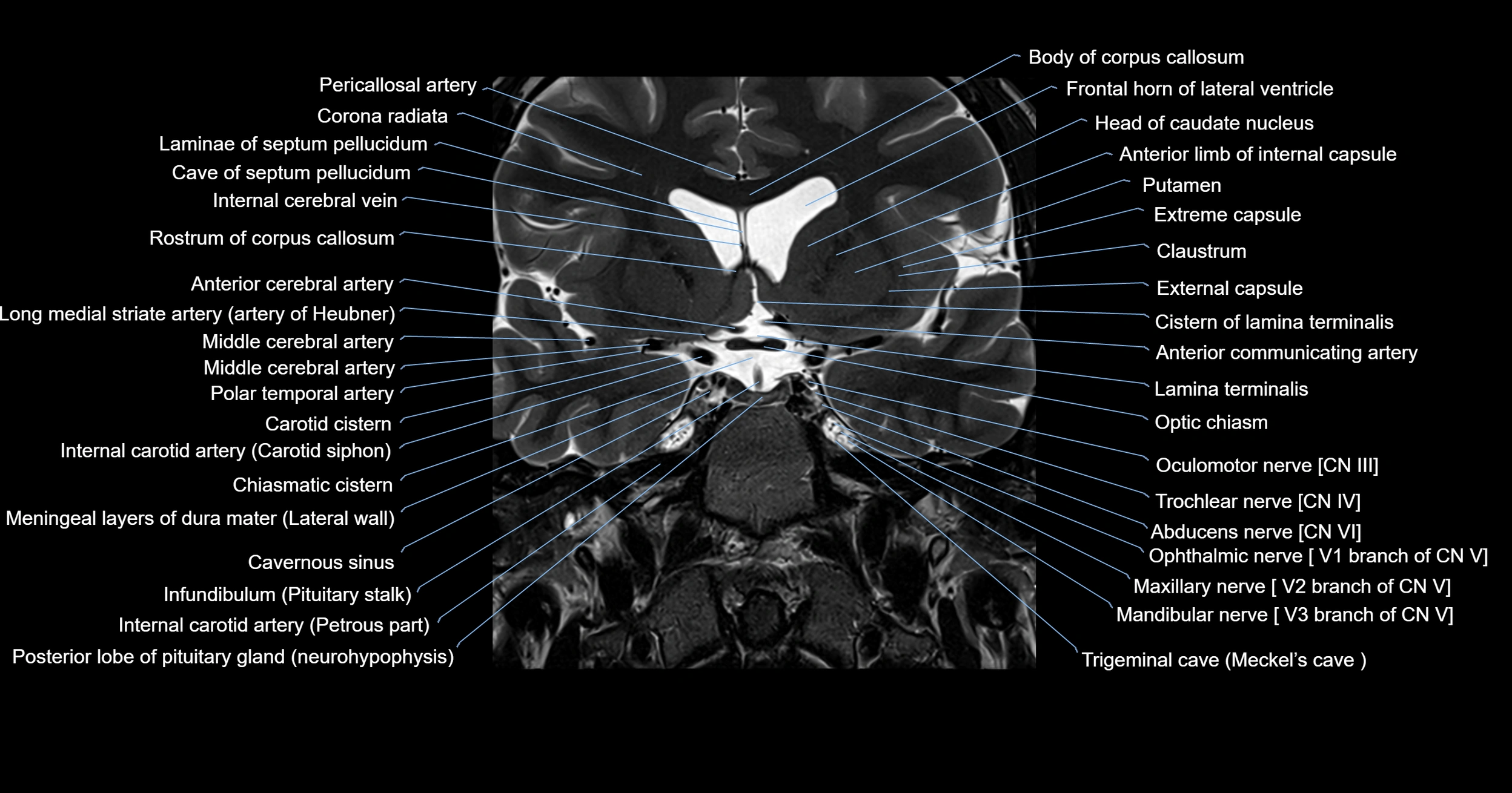 MRI brainstem & basal ganglia anatomy labelled 3T MRI images -img-00001-00012.webp